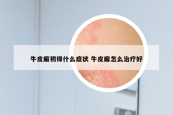牛皮廨初得什么症状 牛皮廨怎么治疗好