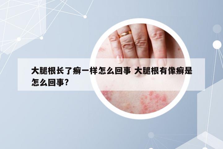 大腿根长了癣一样怎么回事 大腿根有像癣是怎么回事?