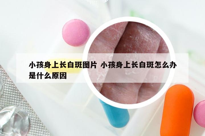 小孩身上长白斑图片 小孩身上长白斑怎么办是什么原因