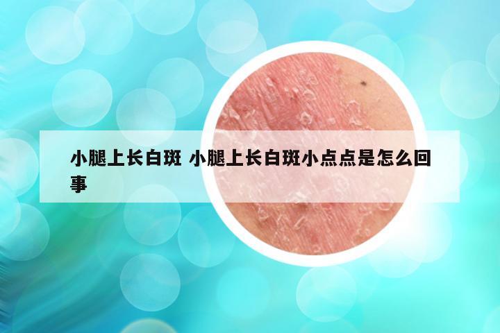 小腿上长白斑 小腿上长白斑小点点是怎么回事