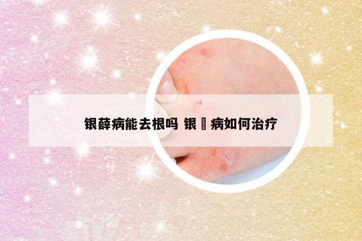 银薛病能去根吗 银痟病如何治疗