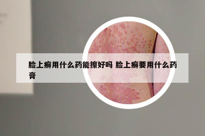 脸上癣用什么药能擦好吗 脸上癣要用什么药膏