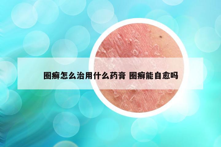 圈癣怎么治用什么药膏 圈癣能自愈吗