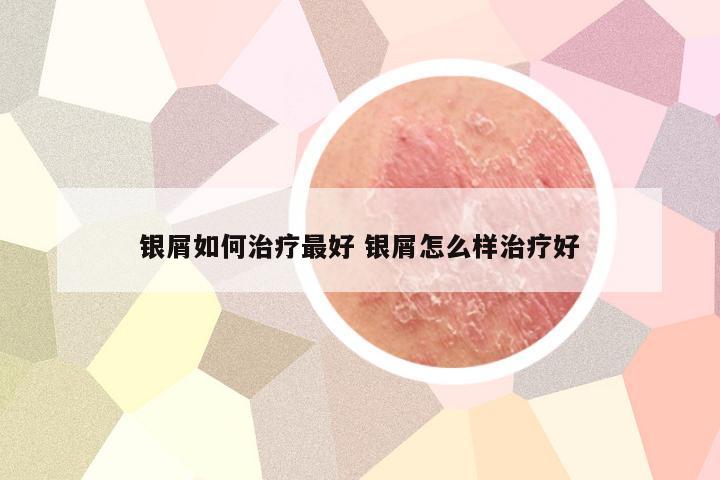 银屑如何治疗最好 银屑怎么样治疗好