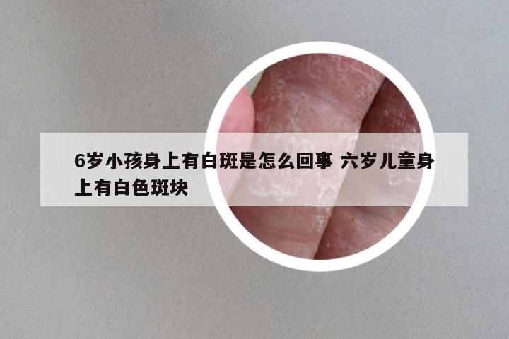 6岁小孩身上有白斑是怎么回事 六岁儿童身上有白色斑块