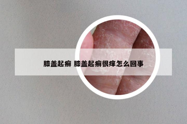 膝盖起癣 膝盖起癣很痒怎么回事