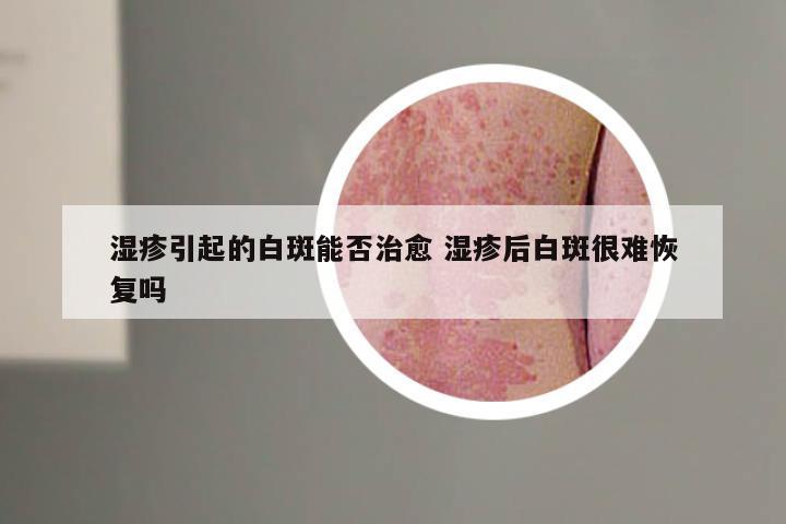 湿疹引起的白斑能否治愈 湿疹后白斑很难恢复吗