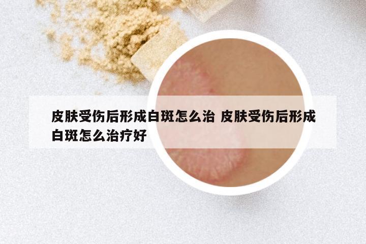 皮肤受伤后形成白斑怎么治 皮肤受伤后形成白斑怎么治疗好