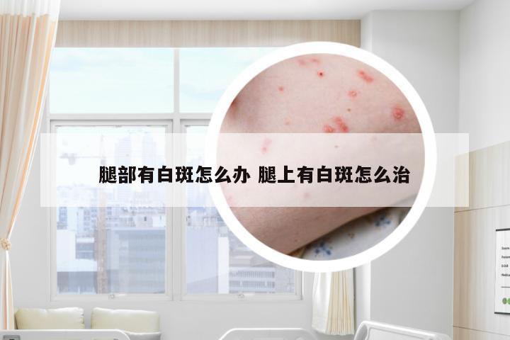 腿部有白斑怎么办 腿上有白斑怎么治