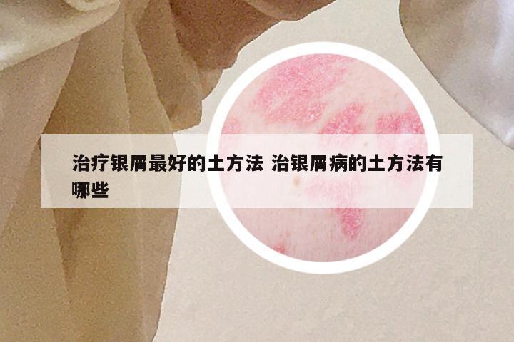 治疗银屑最好的土方法 治银屑病的土方法有哪些