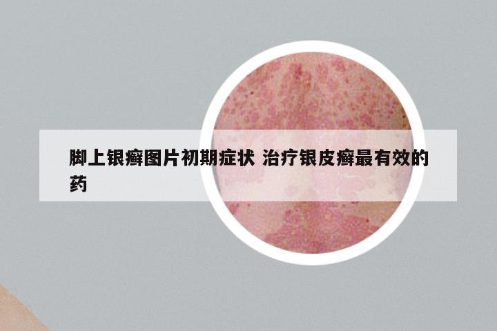 脚上银癣图片初期症状 治疗银皮癣最有效的药