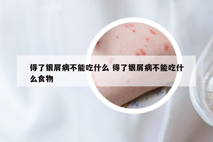 得了银屑病不能吃什么 得了银屑病不能吃什么食物