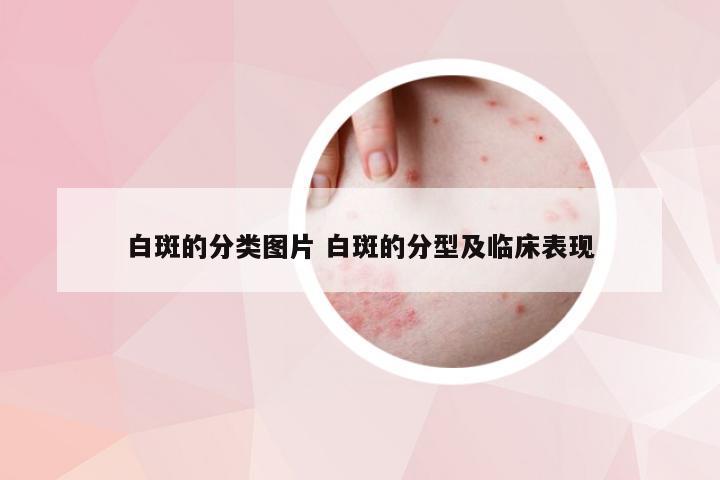 白斑的分类图片 白斑的分型及临床表现