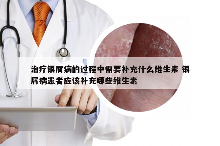 治疗银屑病的过程中需要补充什么维生素 银屑病患者应该补充哪些维生素