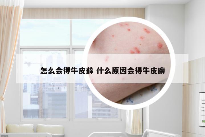 怎么会得牛皮藓 什么原因会得牛皮廨