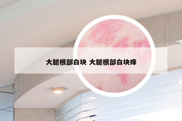 大腿根部白块 大腿根部白块痒