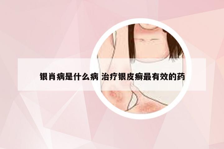 银肖病是什么病 治疗银皮癣最有效的药