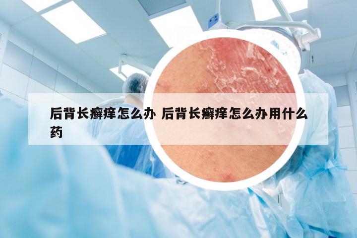 后背长癣痒怎么办 后背长癣痒怎么办用什么药