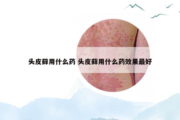 头皮藓用什么药 头皮藓用什么药效果最好