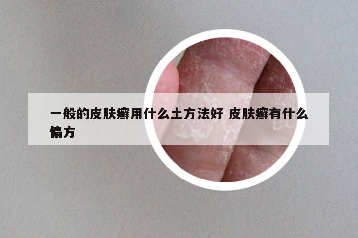 一般的皮肤癣用什么土方法好 皮肤癣有什么偏方