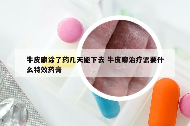 牛皮廨涂了药几天能下去 牛皮廨治疗需要什么特效药膏