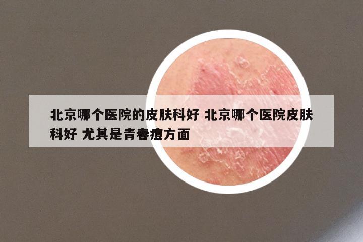 北京哪个医院的皮肤科好 北京哪个医院皮肤科好 尤其是青春痘方面