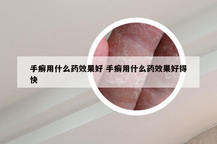 手癣用什么药效果好 手癣用什么药效果好得快