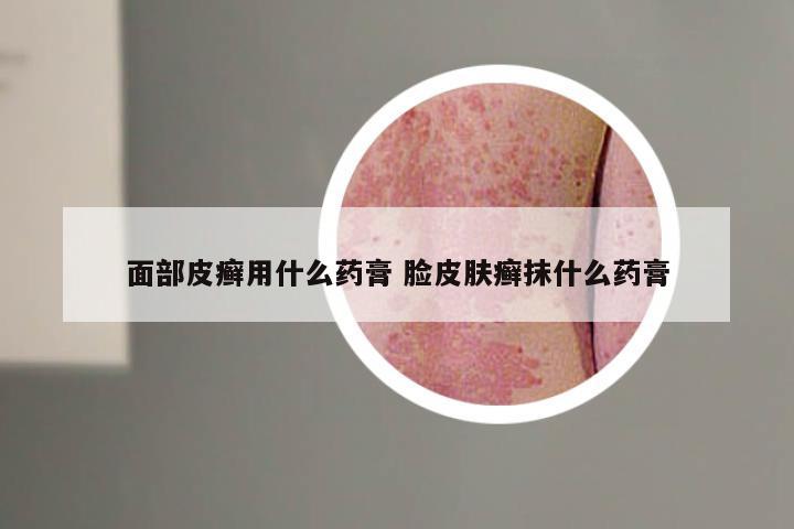 面部皮癣用什么药膏 脸皮肤癣抹什么药膏