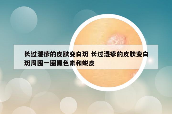 长过湿疹的皮肤变白斑 长过湿疹的皮肤变白斑周围一圈黑色素和蜕皮