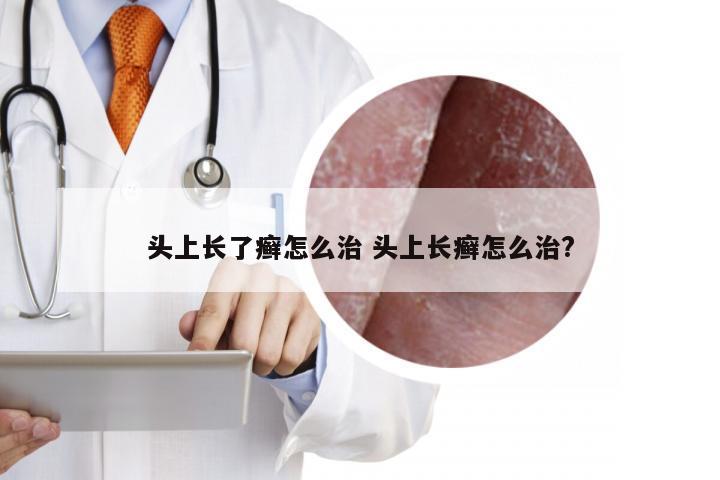 头上长了癣怎么治 头上长癣怎么治?