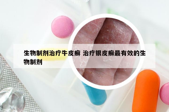 生物制剂治疗牛皮癣 治疗银皮癣最有效的生物制剂