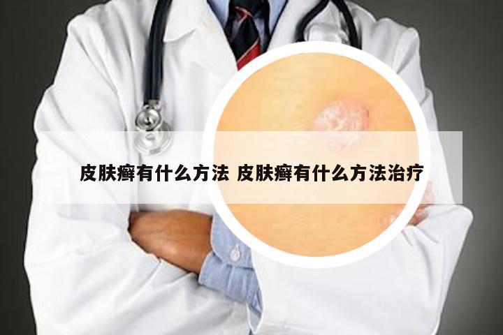 皮肤癣有什么方法 皮肤癣有什么方法治疗