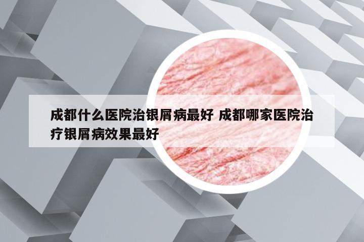 成都什么医院治银屑病最好 成都哪家医院治疗银屑病效果最好