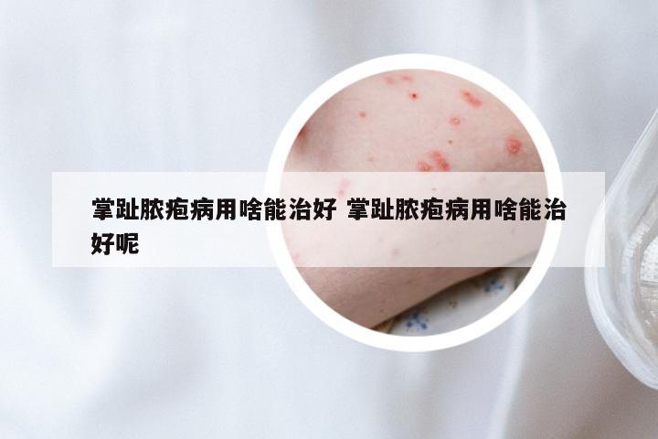 掌趾脓疱病用啥能治好 掌趾脓疱病用啥能治好呢