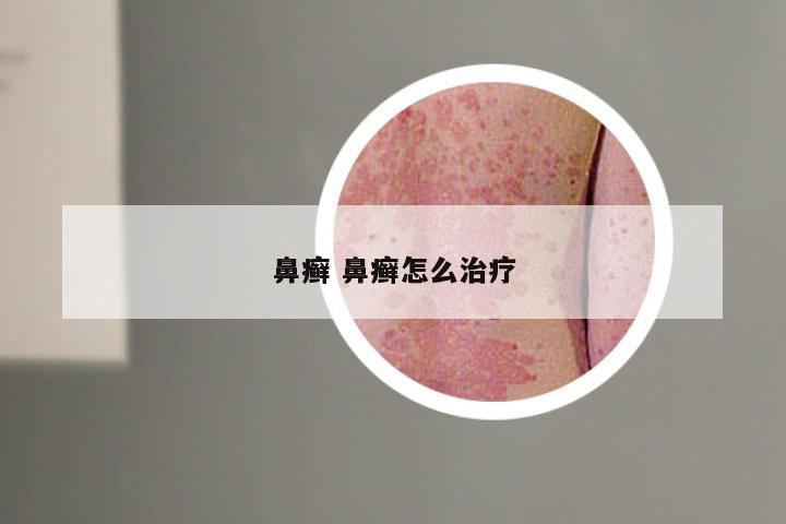 鼻癣 鼻癣怎么治疗