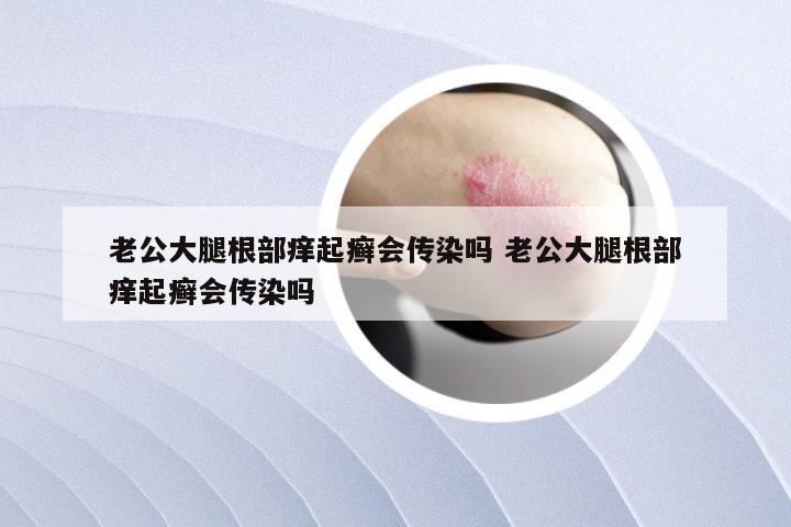 老公大腿根部痒起癣会传染吗 老公大腿根部痒起癣会传染吗