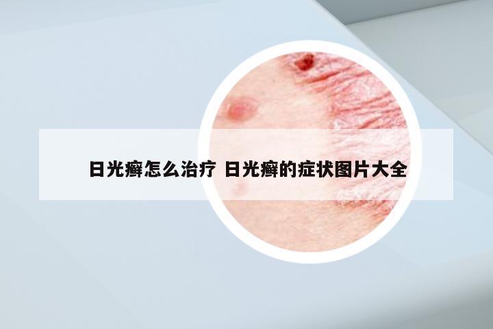 日光癣怎么治疗 日光癣的症状图片大全