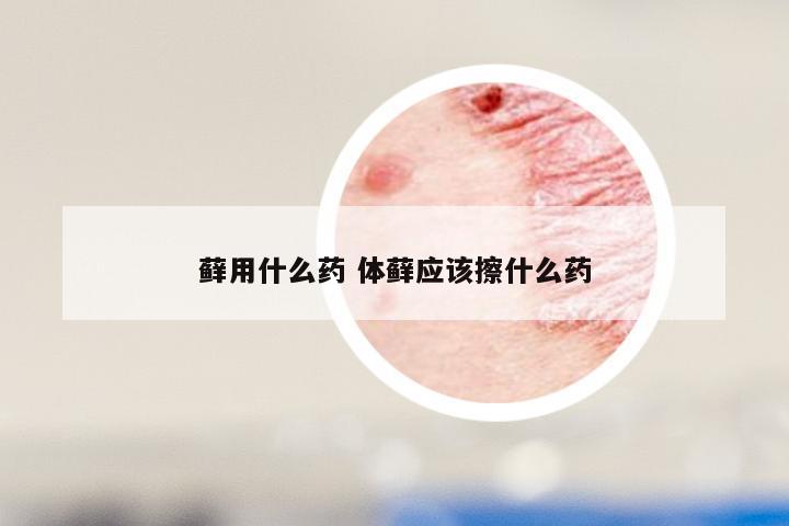 藓用什么药 体藓应该擦什么药