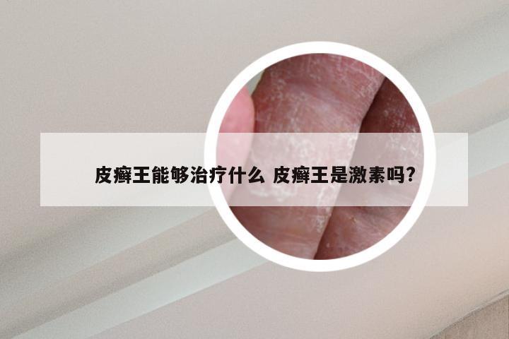 皮癣王能够治疗什么 皮癣王是激素吗?