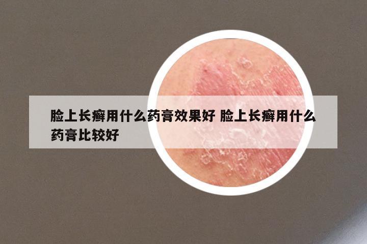 脸上长癣用什么药膏效果好 脸上长癣用什么药膏比较好