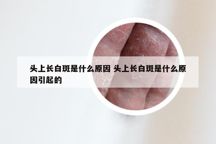 头上长白斑是什么原因 头上长白斑是什么原因引起的