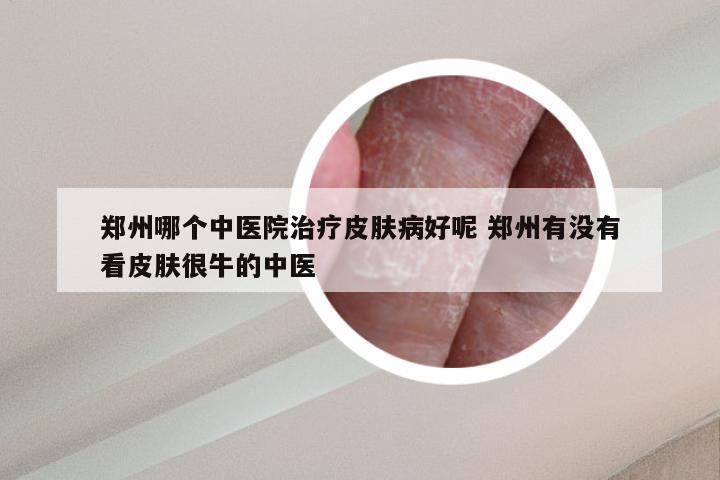 郑州哪个中医院治疗皮肤病好呢 郑州有没有看皮肤很牛的中医