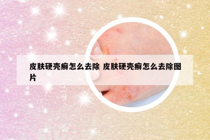 皮肤硬壳癣怎么去除 皮肤硬壳癣怎么去除图片