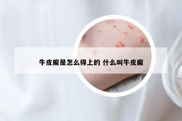 牛皮廨是怎么得上的 什么叫牛皮廨