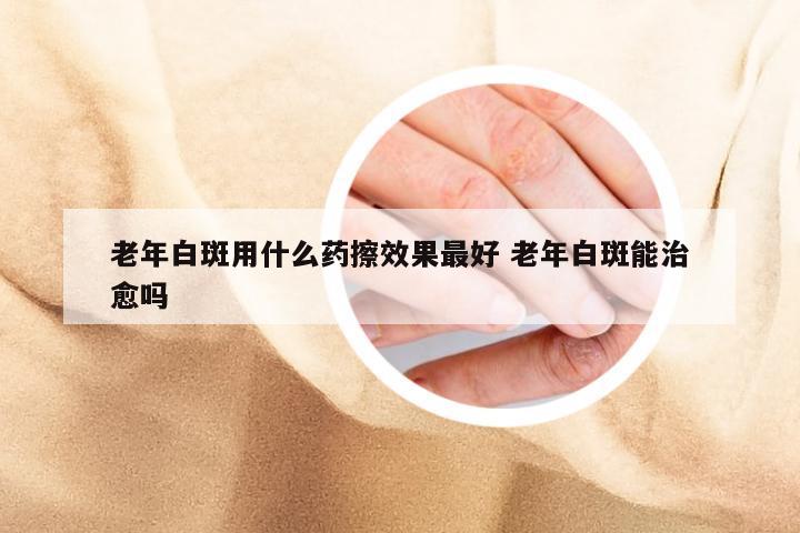 老年白斑用什么药擦效果最好 老年白斑能治愈吗