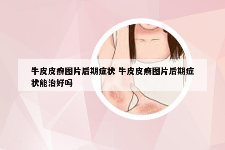 牛皮皮癣图片后期症状 牛皮皮癣图片后期症状能治好吗