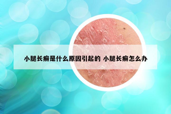 小腿长癣是什么原因引起的 小腿长癣怎么办