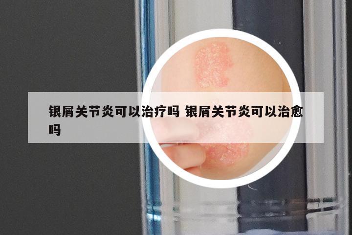 银屑关节炎可以治疗吗 银屑关节炎可以治愈吗