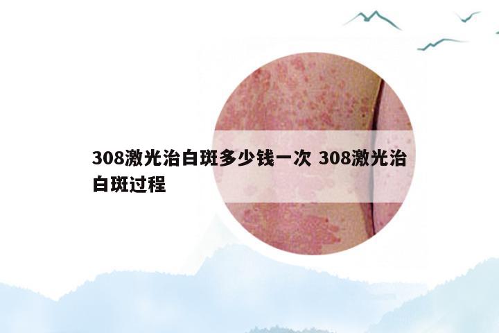 308激光治白斑多少钱一次 308激光治白斑过程