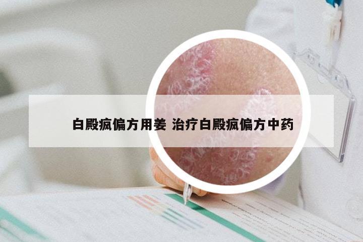 白殿疯偏方用姜 治疗白殿疯偏方中药